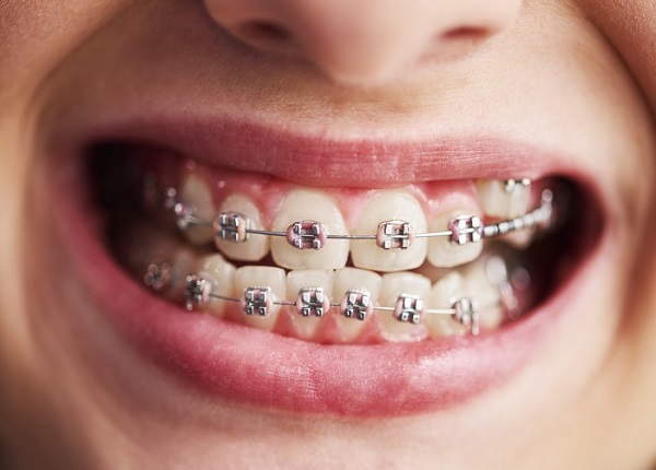 teeth braces price